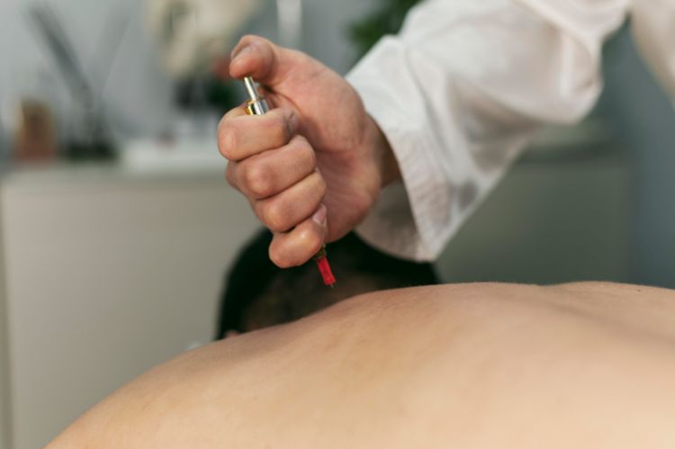Acupuncture